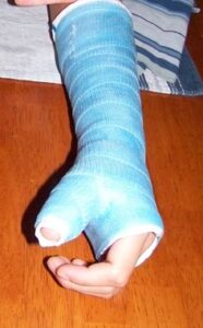 Broken Wrist