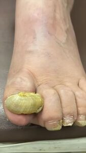 Fungus On Toes